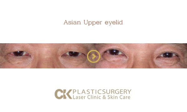 Patient's eyes before and after upper eyelid surgery for sagging skin in Southern California