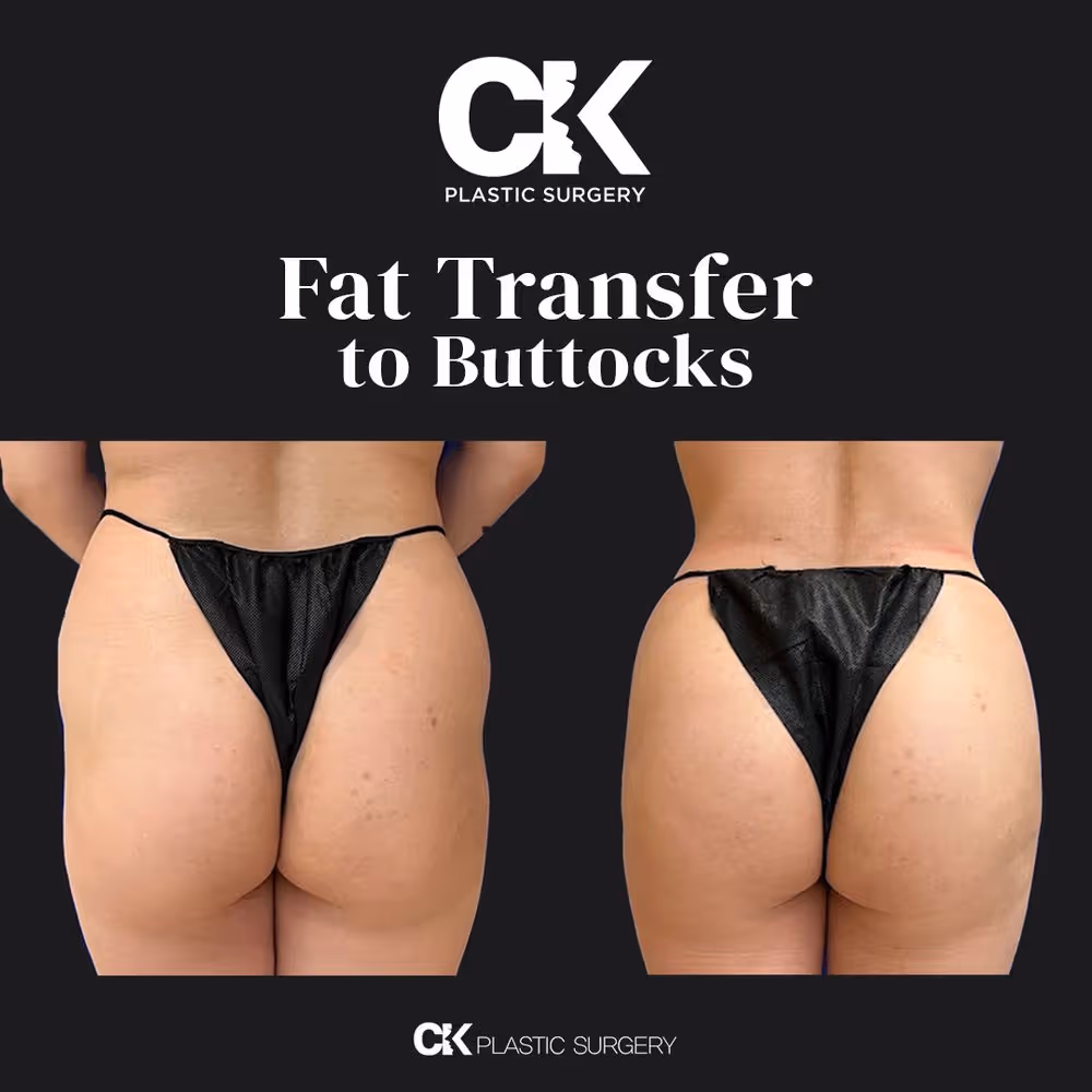 BBL in Los Angeles at Korean plastic surgery 