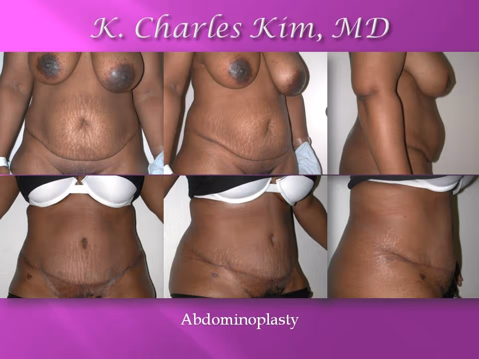 Los Angeles Abdominoplasty at the best plastic surgeon