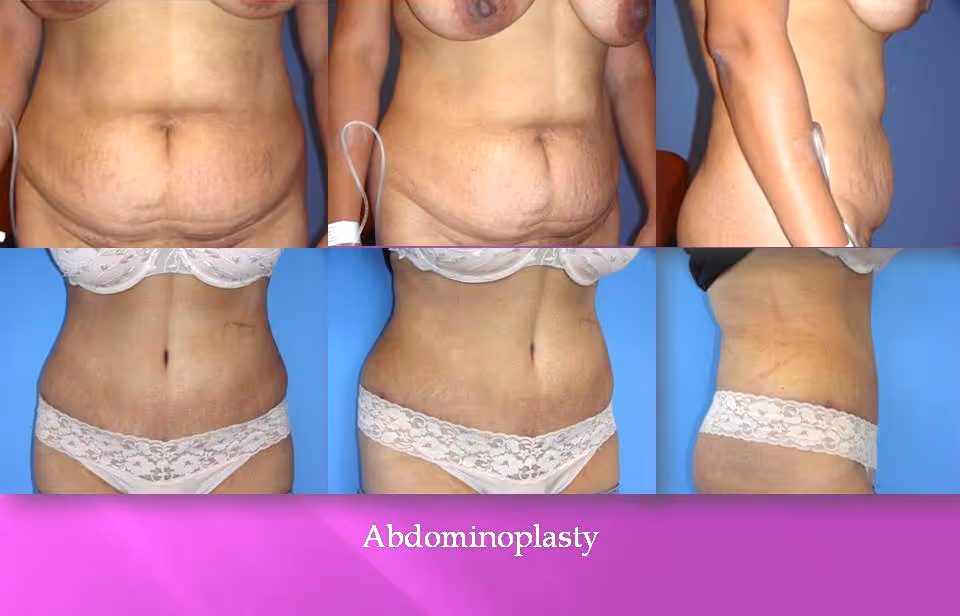 Los Angeles Abdominoplasty at the best plastic surgeon