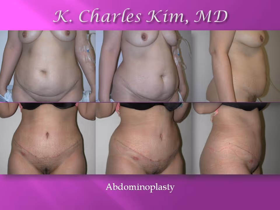 Before and after abdominoplasty results showing a flattened stomach and tightened core in Los Angeles