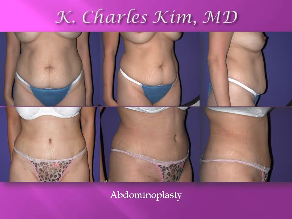 Before and after abdominoplasty results showing a flattened stomach and tightened core in Los Angeles