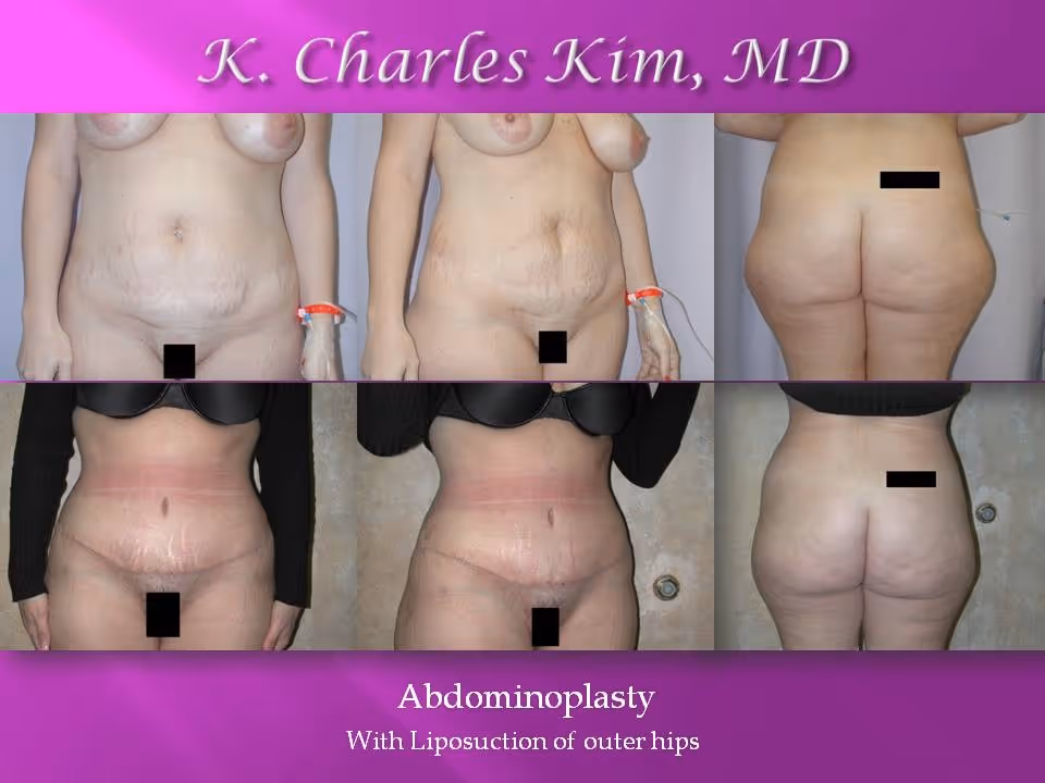 Los Angeles Abdominoplasty at the best plastic surgeon CK Plastic Surgery. Korean Plastic Surgeon