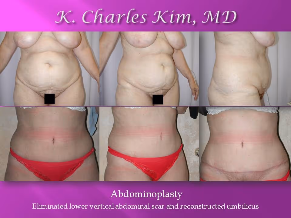 Los Angeles Abdominoplasty at the best plastic surgeon CK Plastic Surgery. Korean Plastic Surgeon