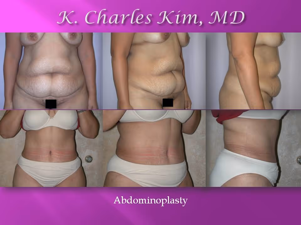 Los Angeles Abdominoplasty at the best plastic surgeon