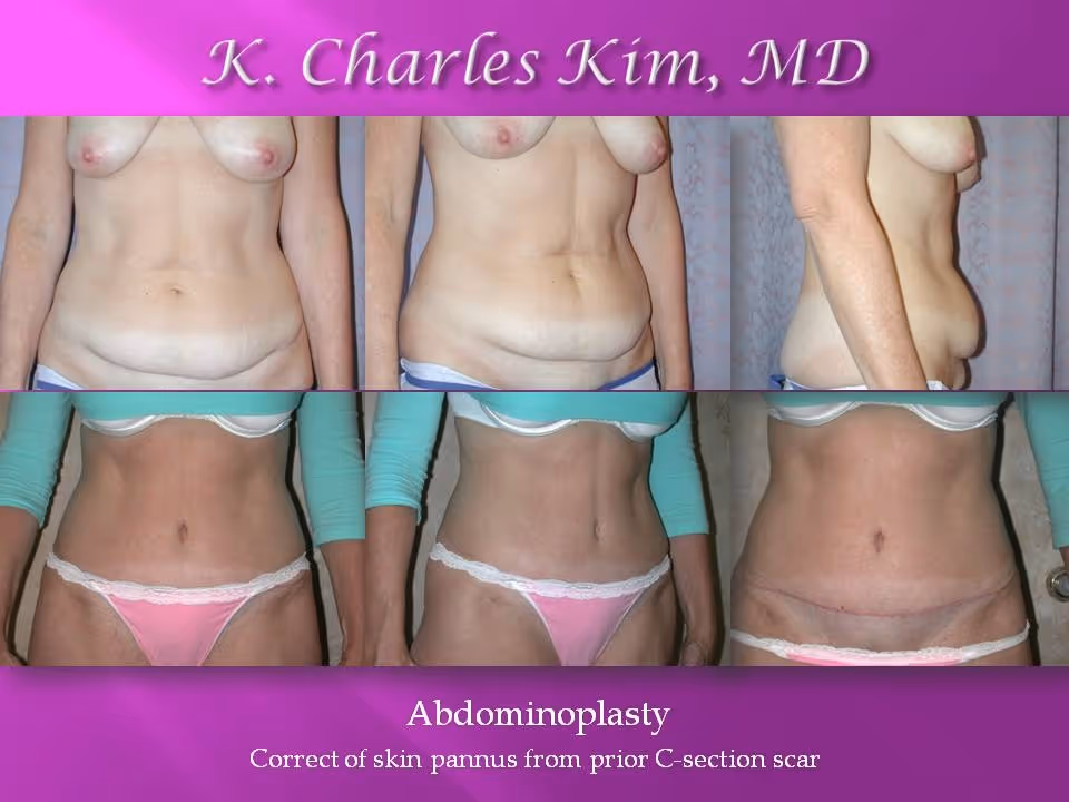 Los Angeles Abdominoplasty at the best plastic surgeon CK Plastic Surgery. Korean Plastic Surgeon