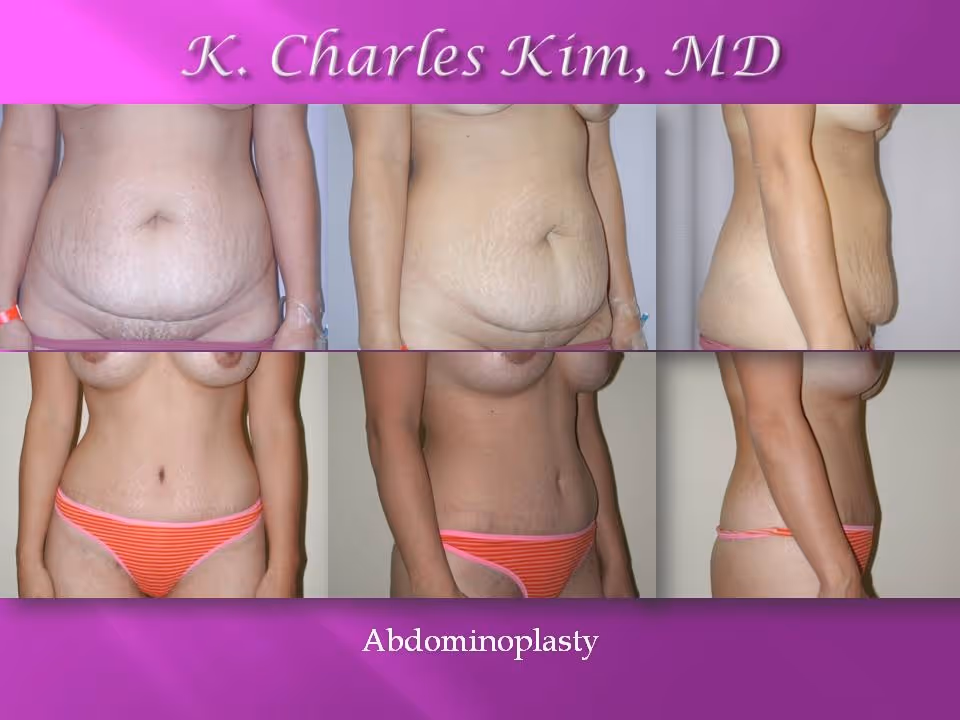 Before and after abdominoplasty results showing a flattened stomach and tightened core in Los Angeles