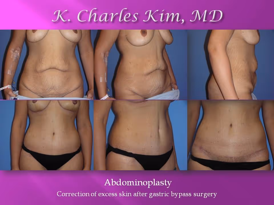 Los Angeles Abdominoplasty at the best plastic surgeon CK Plastic Surgery. Korean Plastic Surgeon