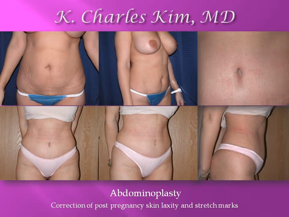 Before and after abdominoplasty results showing a flattened stomach and tightened core in Los Angeles
