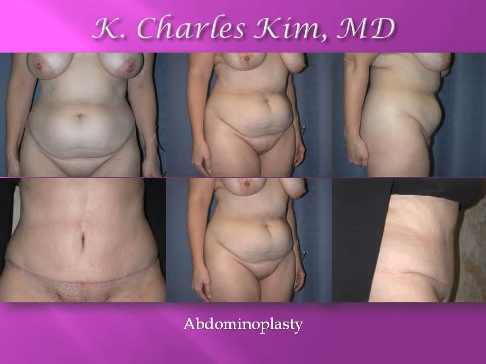 Before and after abdominoplasty results showing a flattened stomach and tightened core in Los Angeles