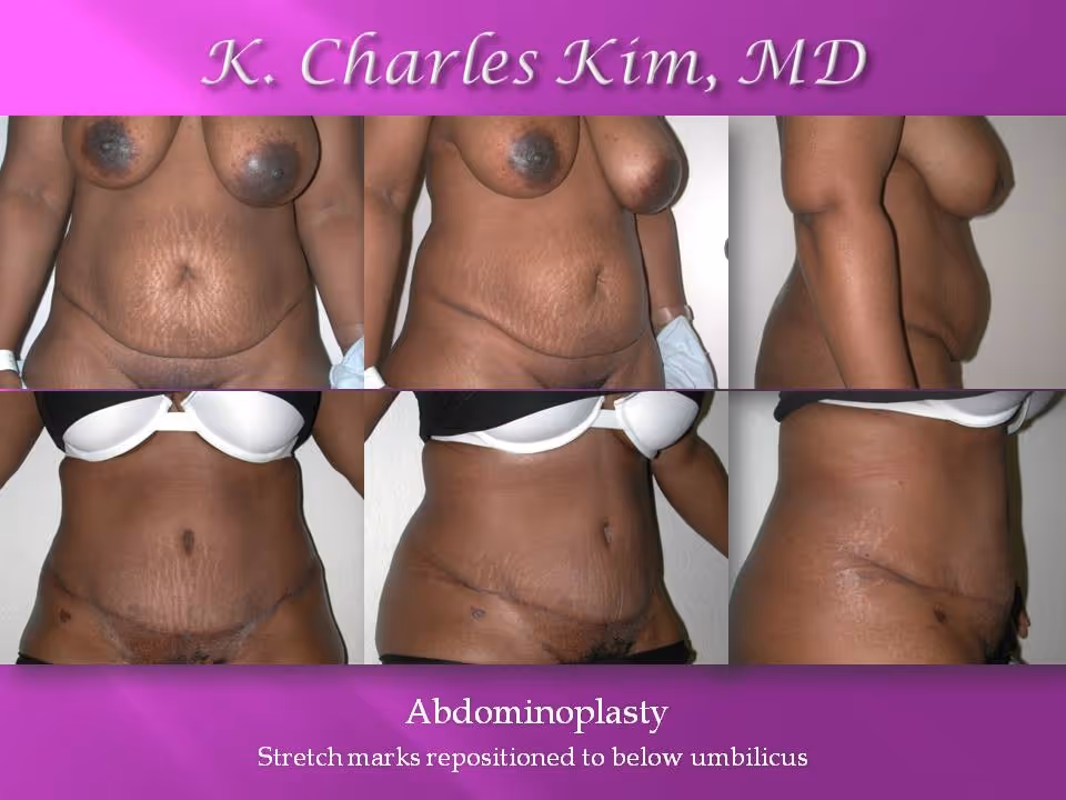 Los Angeles Abdominoplasty at the best plastic surgeon CK Plastic Surgery. Korean Plastic Surgeon