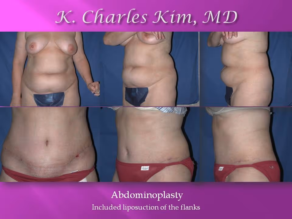 Los Angeles Abdominoplasty at the best plastic surgeon CK Plastic Surgery. Korean Plastic Surgeon