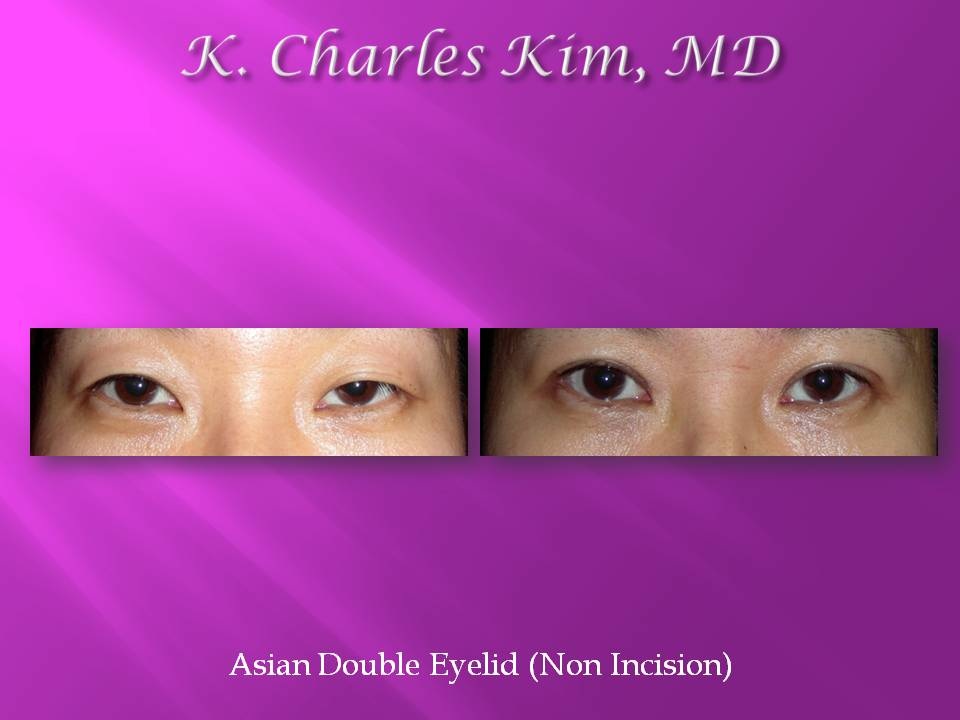 Belpharoplasty at Korean plastic surgeon in Los Angeles/