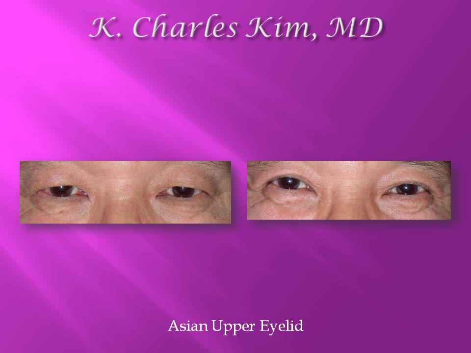 Belpharoplasty at Korean plastic surgeon in Los Angeles/