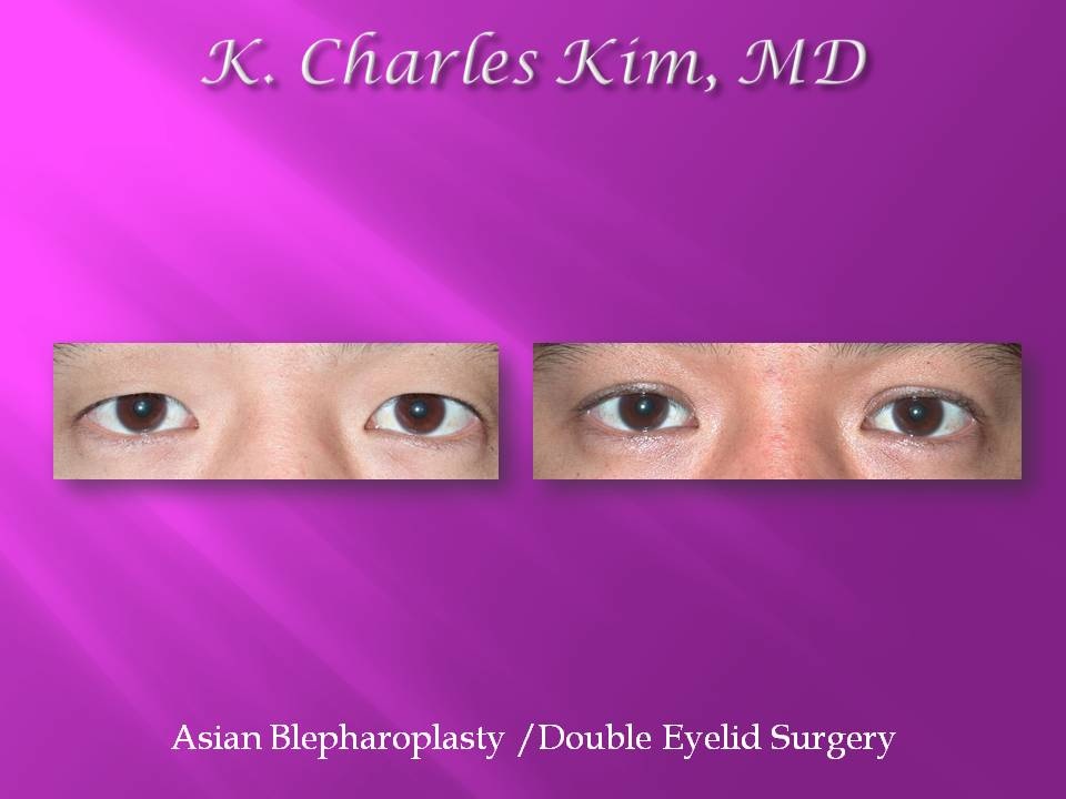 Before and after upper blepharoplasty results, removing hooded eyelid skin in Los Angeles