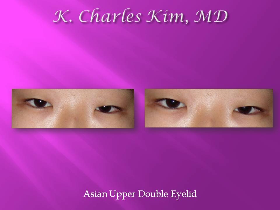 Patient's eyes before and after lower blepharoplasty to reduce under-eye bags in Southern California