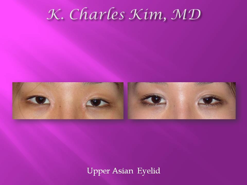 Patient's eyes before and after lower blepharoplasty to reduce under-eye bags in Southern California