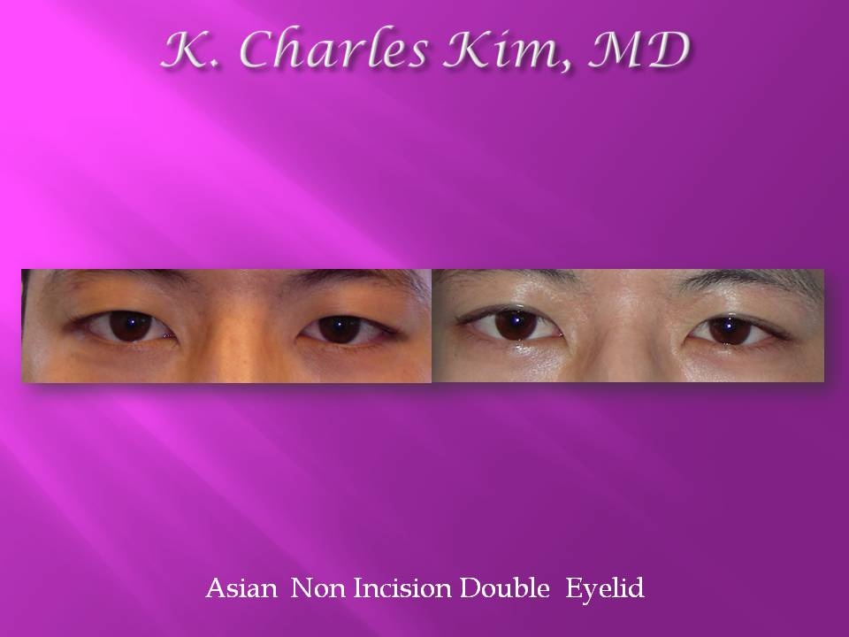 Before and after upper blepharoplasty results, removing hooded eyelid skin in Los Angeles