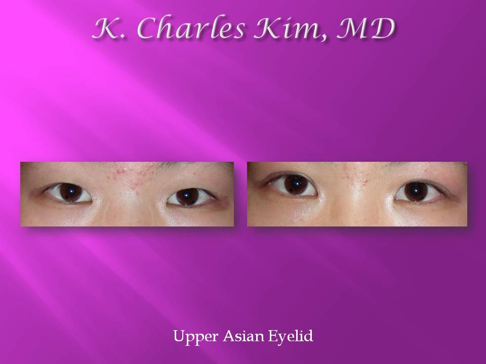 Patient's eyes before and after lower blepharoplasty to reduce under-eye bags in Southern California