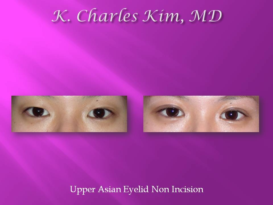 Before and after upper blepharoplasty results, removing hooded eyelid skin in Los AngelesPatient's eyes before and after lower blepharoplasty to reduce under-eye bags in Southern California