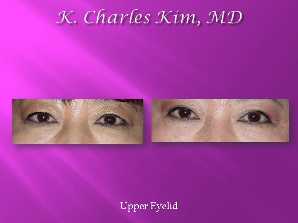 Before and after upper blepharoplasty results, removing hooded eyelid skin in Los Angeles