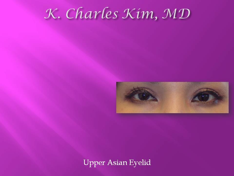 Patient's eyes before and after lower blepharoplasty to reduce under-eye bags in Southern California