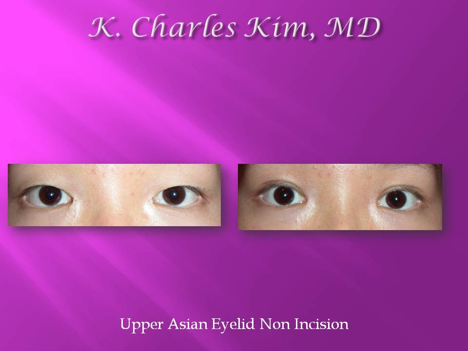 Patient's eyes before and after lower blepharoplasty to reduce under-eye bags in Southern California