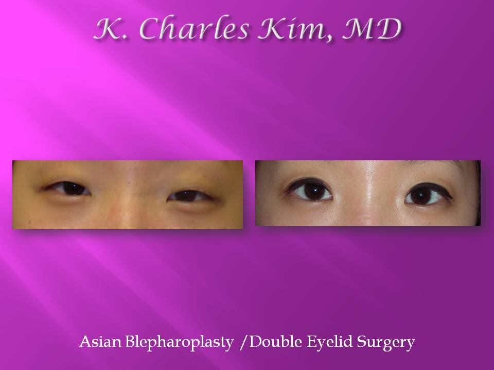Before and after upper blepharoplasty results, removing hooded eyelid skin in Los Angeles