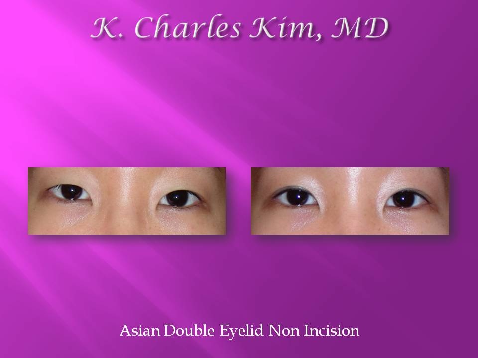 Patient's eyes before and after lower blepharoplasty to reduce under-eye bags in Southern California