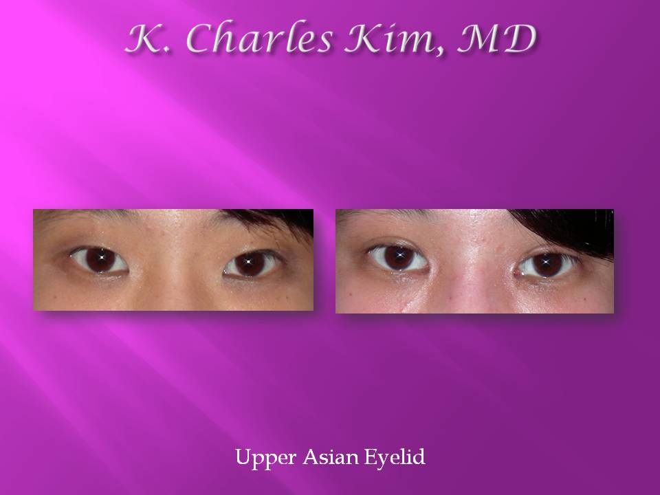 Patient's eyes before and after lower blepharoplasty to reduce under-eye bags in Southern California