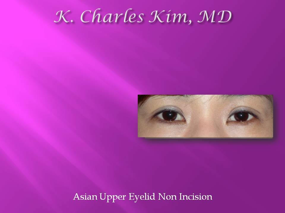 Patient's eyes before and after lower blepharoplasty to reduce under-eye bags in Southern California