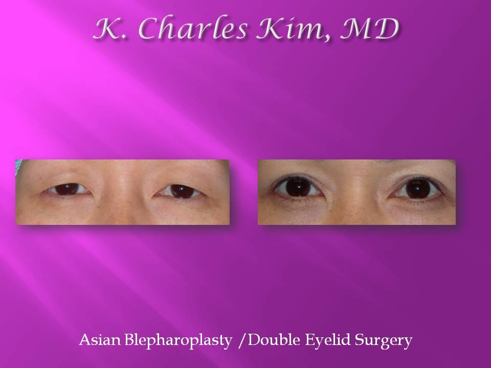 Before and after upper blepharoplasty results, removing hooded eyelid skin in Los Angeles
