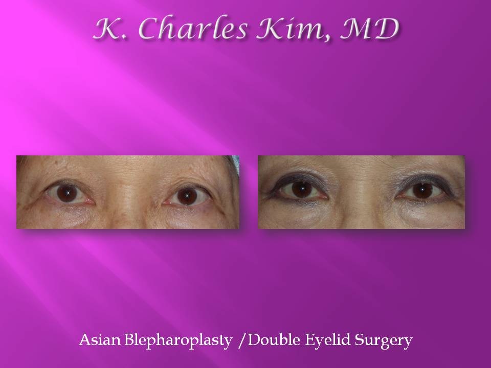 Before and after upper blepharoplasty results, removing hooded eyelid skin in Los Angeles