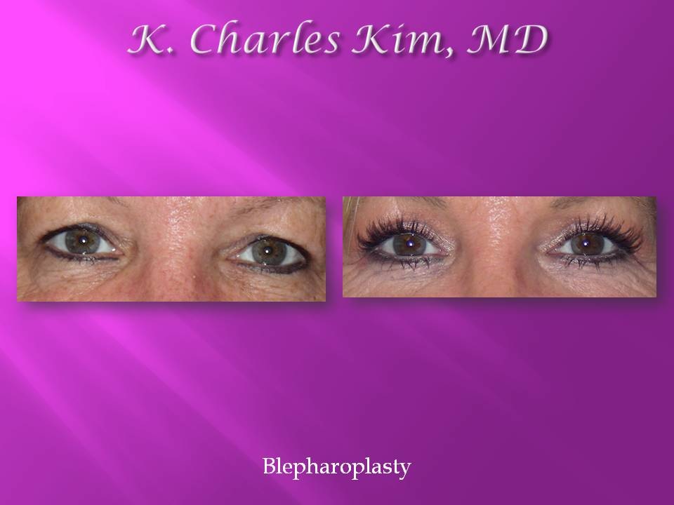Before and after upper blepharoplasty results, removing hooded eyelid skin in Los Angeles