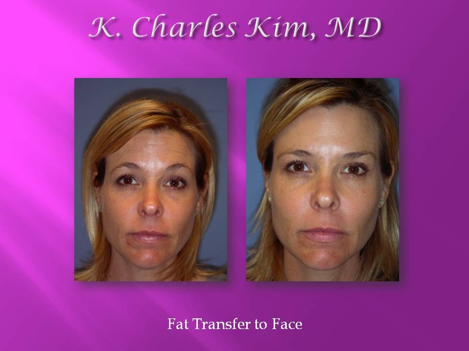 Before and after facelift results showing a smoother jawline and tighter neck