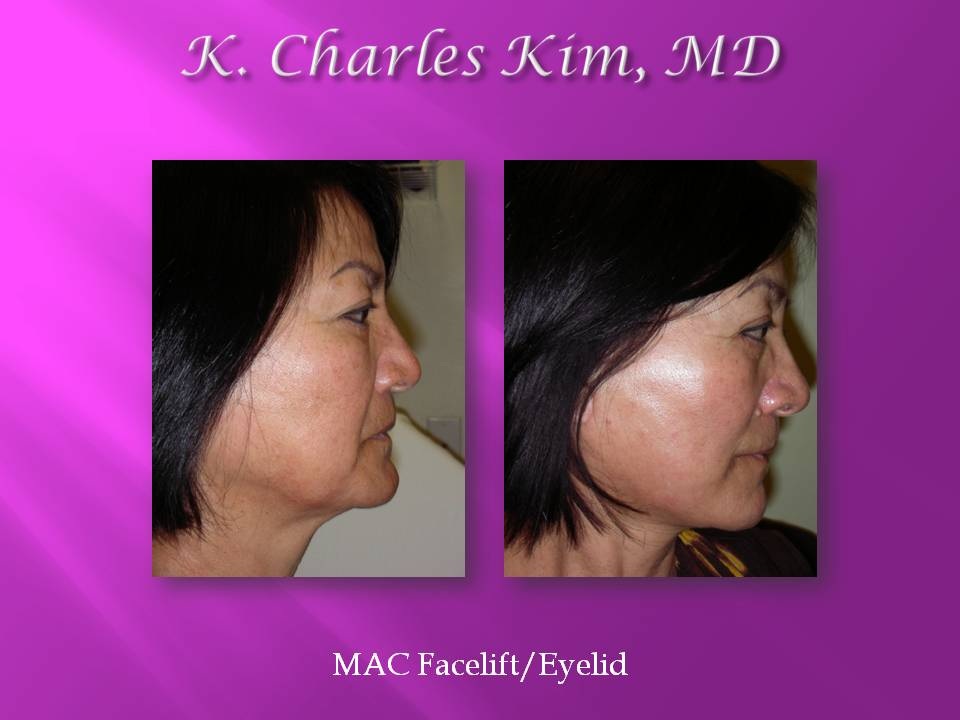 Before and after facelift results showing a smoother jawline and tighter neck