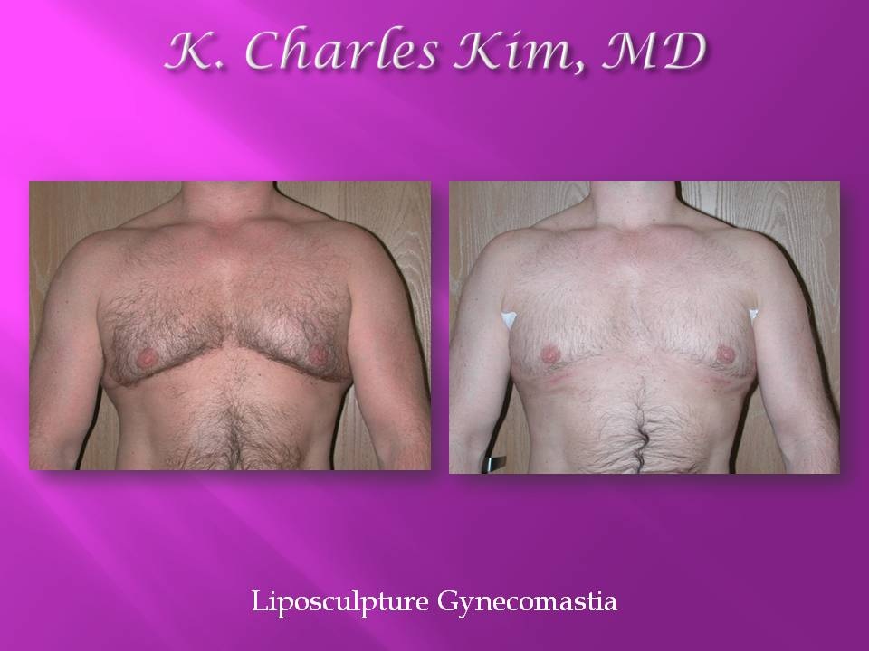 Before and after male gynecomastia surgery, showing a flatter, more contoured chest in Los Angeles