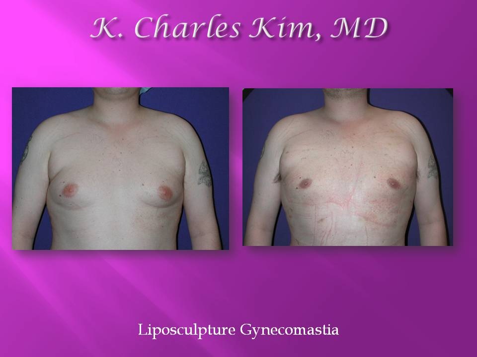 Before and after male gynecomastia surgery, showing a flatter, more contoured chest in Los Angeles