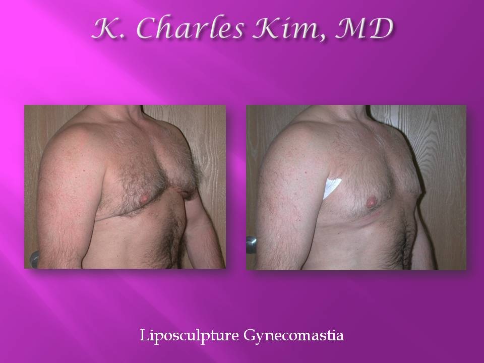 Before and after male gynecomastia surgery, showing a flatter, more contoured chest in Los Angeles