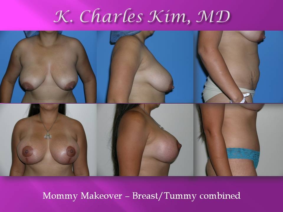 Before and after tummy tuck results, showing a flattened abdomen and tightened core in Los Angeles