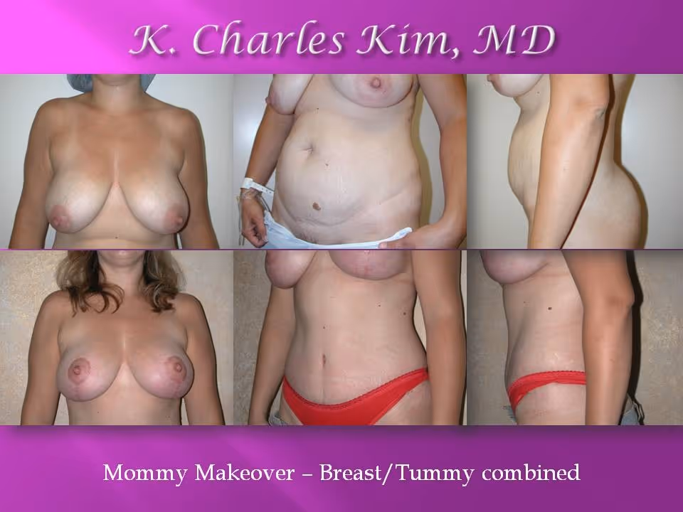 Best Plastic Surgeon in Los Angeles for Breast Augmentation