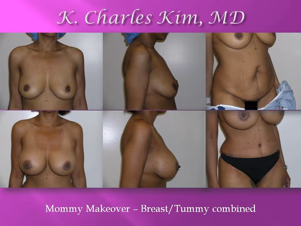 Best Plastic Surgeon in Los Angeles for Breast Augmentation