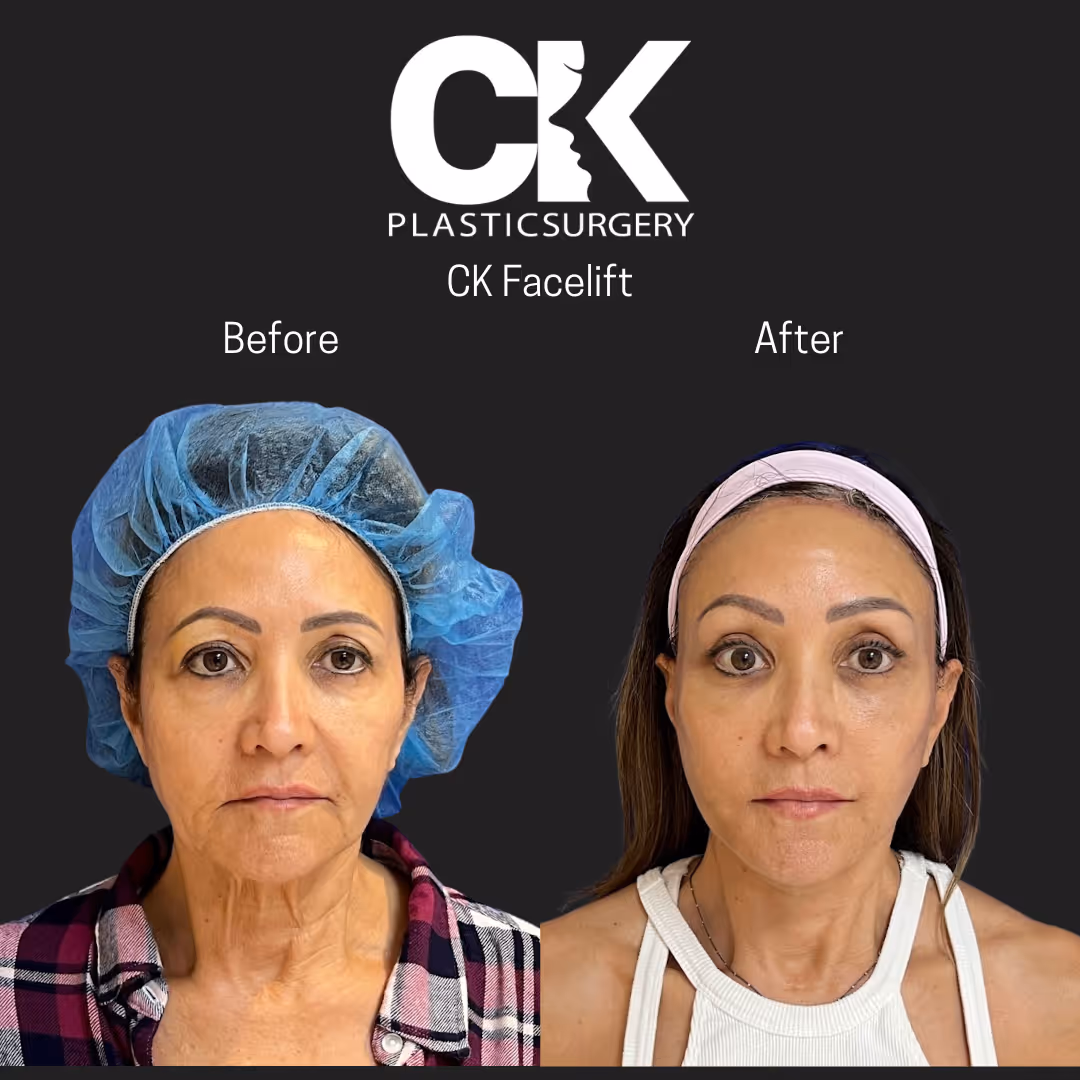 Best Facelift in Los Angeles for women