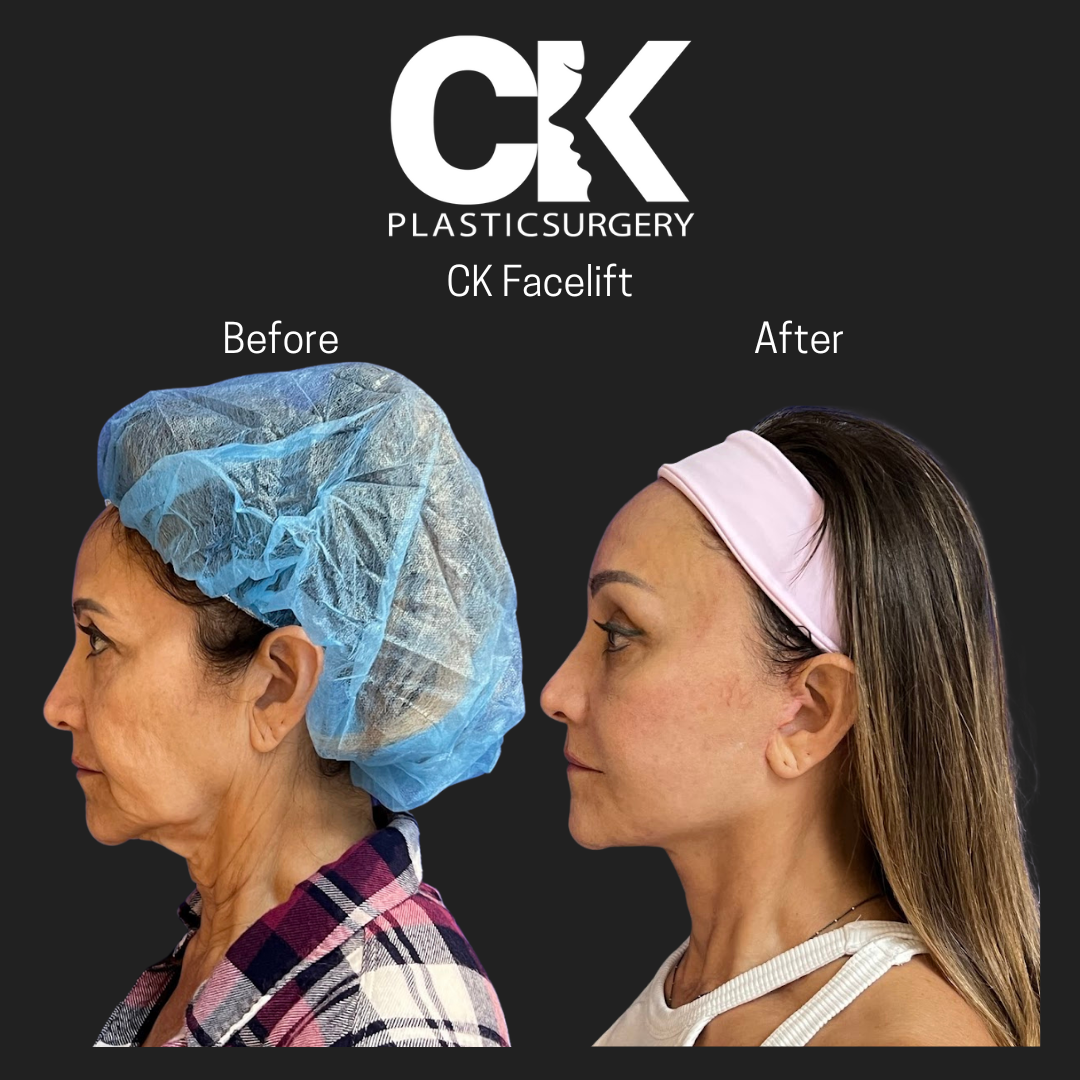 Amazing facelift transformation in Los Angeles