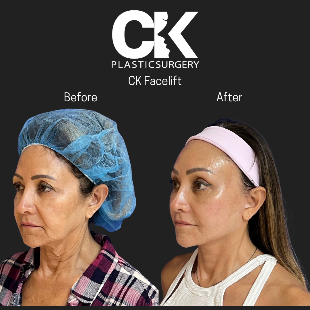 Doctor Charles Kim example of facelift in Los Angeles. Plastic Surgery clinic Korean