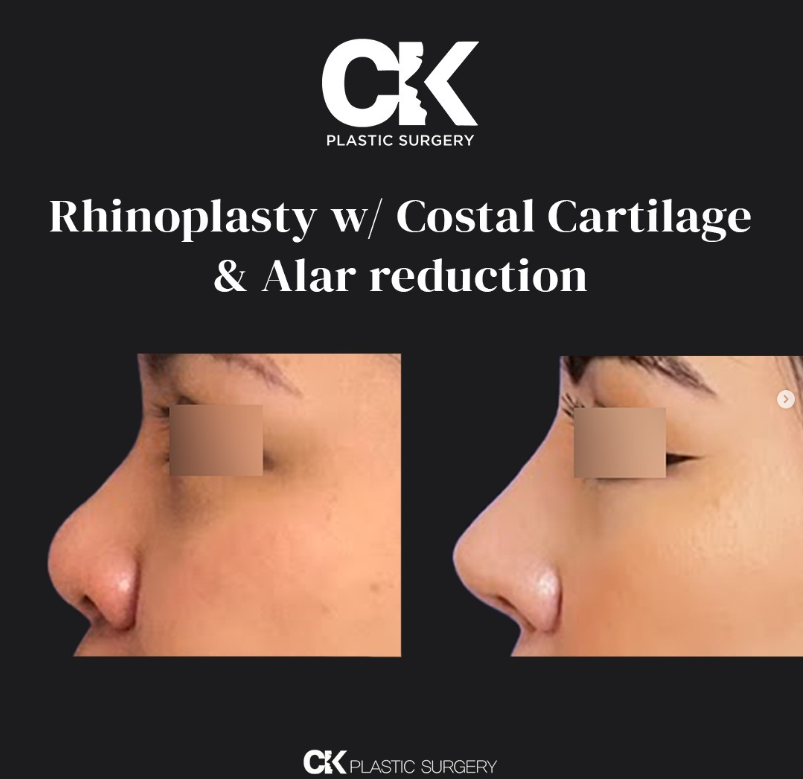 Alar Reduction in Los Angeles at Korean Plastic Surgery clinic CK Plastic Surgery, refreshed and perfect plastic surgery