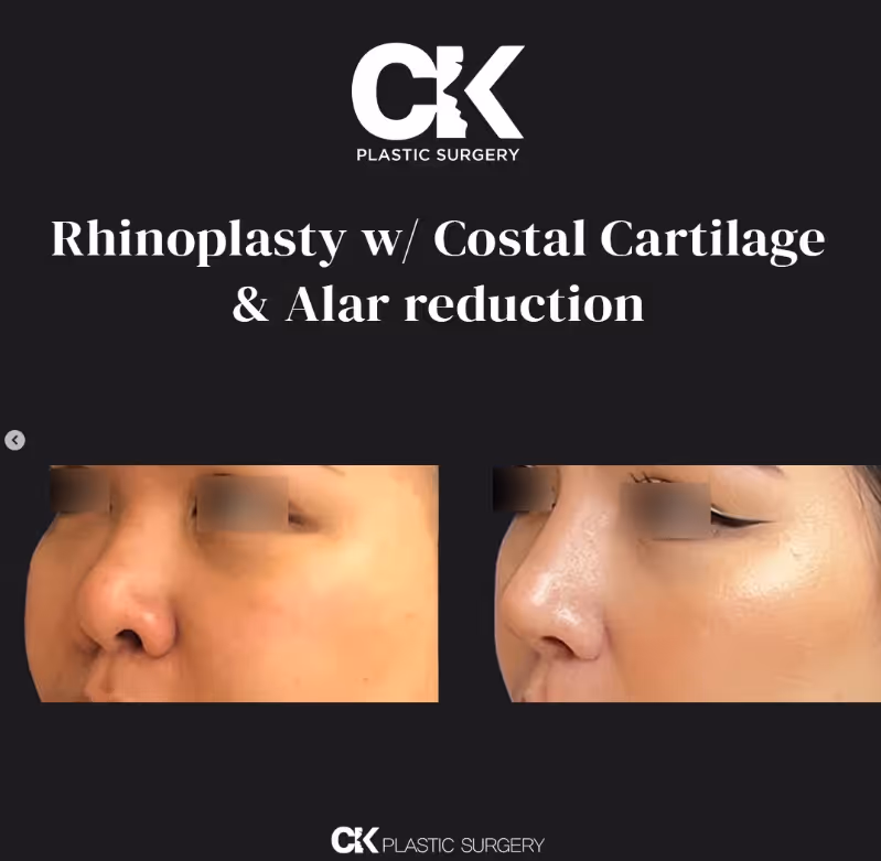 Alar Reduction in Los Angeles at Korean Plastic Surgery clinic CK Plastic Surgery, refreshed and perfect plastic surgery