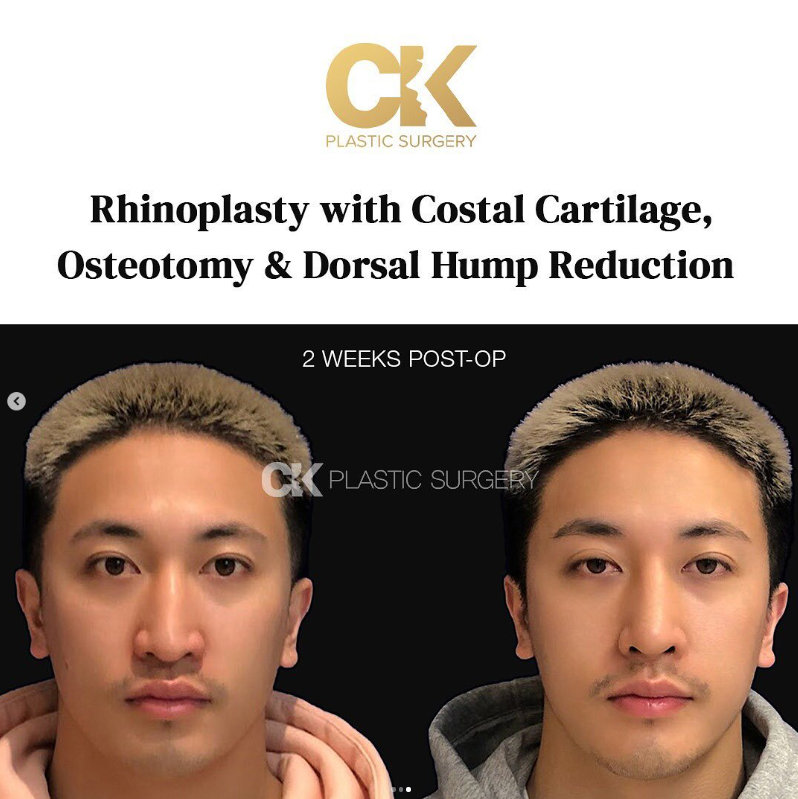 Before and after photos of dorsal hump reduction surgery performed by Dr. Kim in Los Angeles