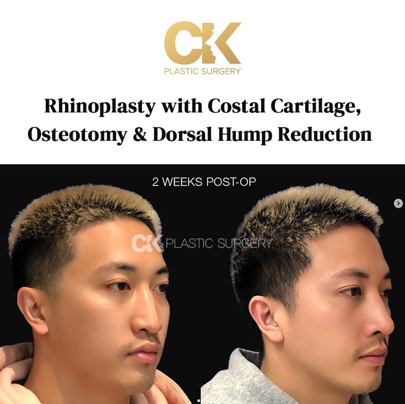 Refined nasal bridge and straighter profile from dorsal hump reduction at CK Plastic Surgery, Los Angeles
