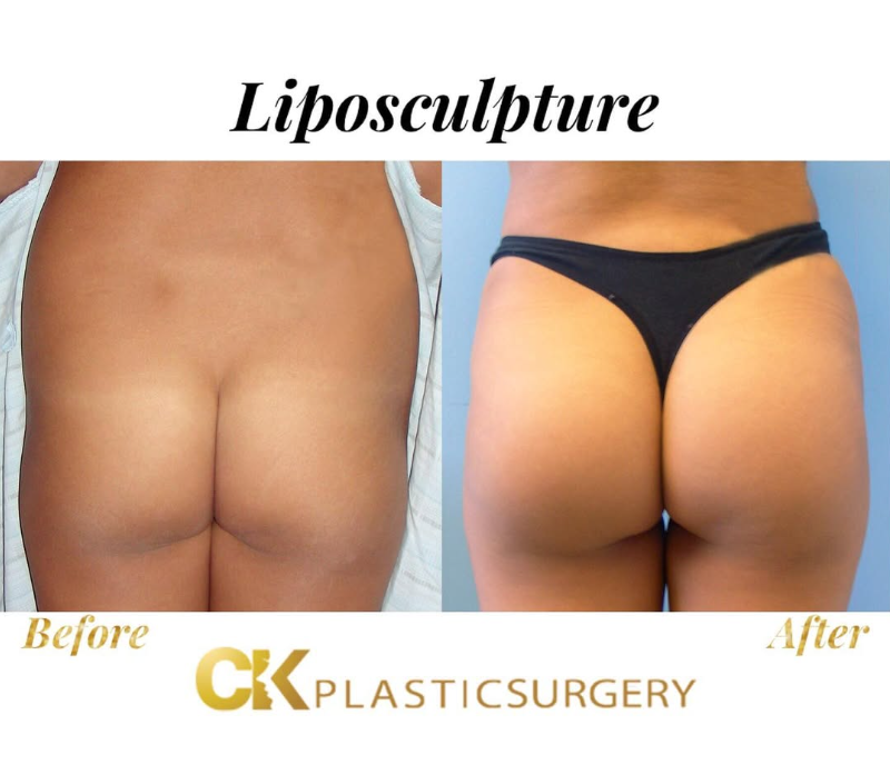 Sculpted buttocks and improved silhouette after BBL surgery at CK Plastic Surgery, Los Angeles